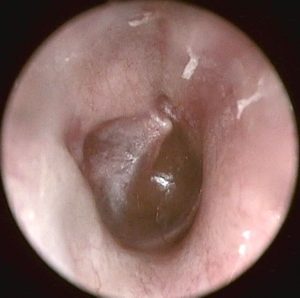 Urechea dreapta